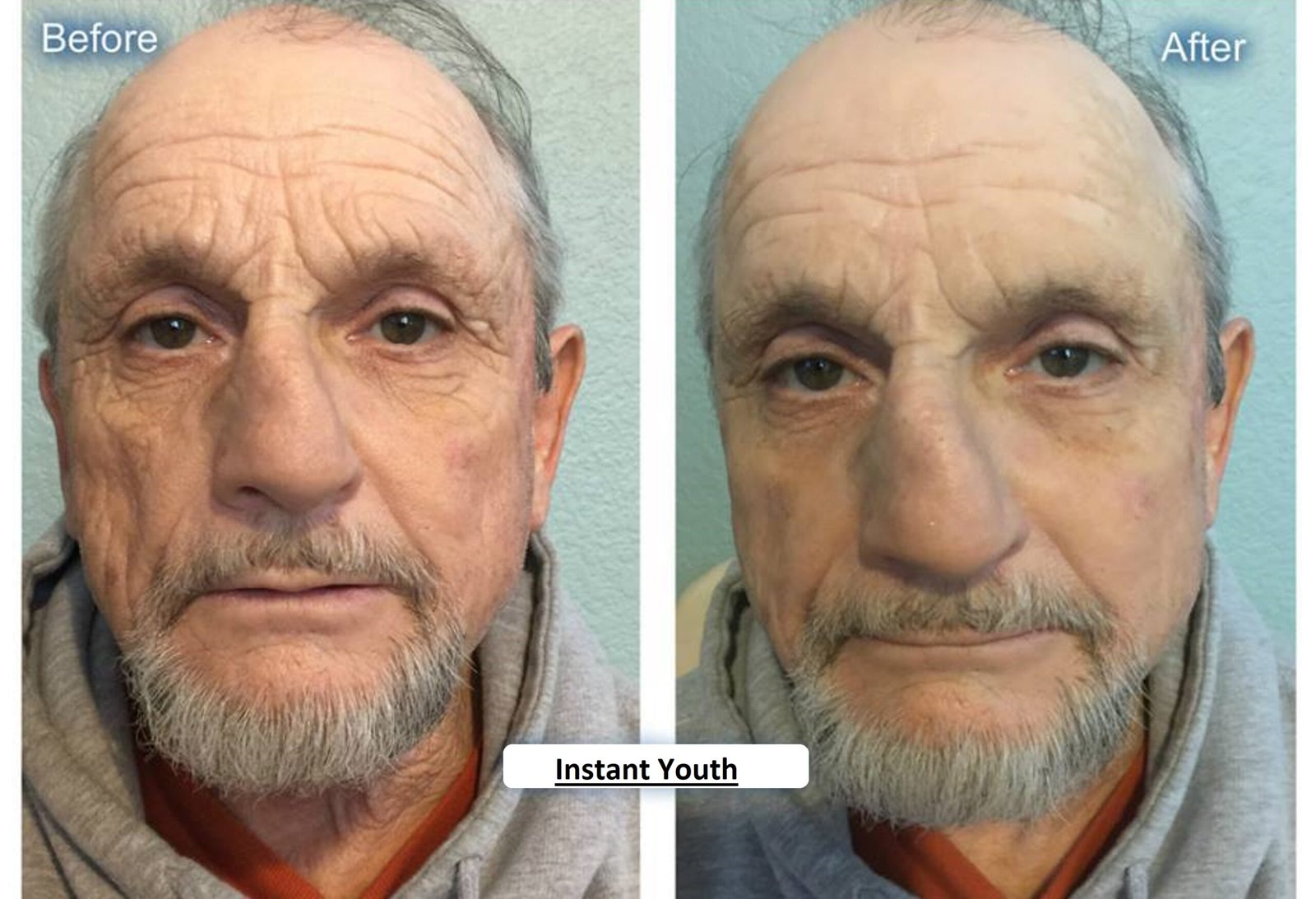 instant-youth-before-after-2 instant-youth-before-after-2